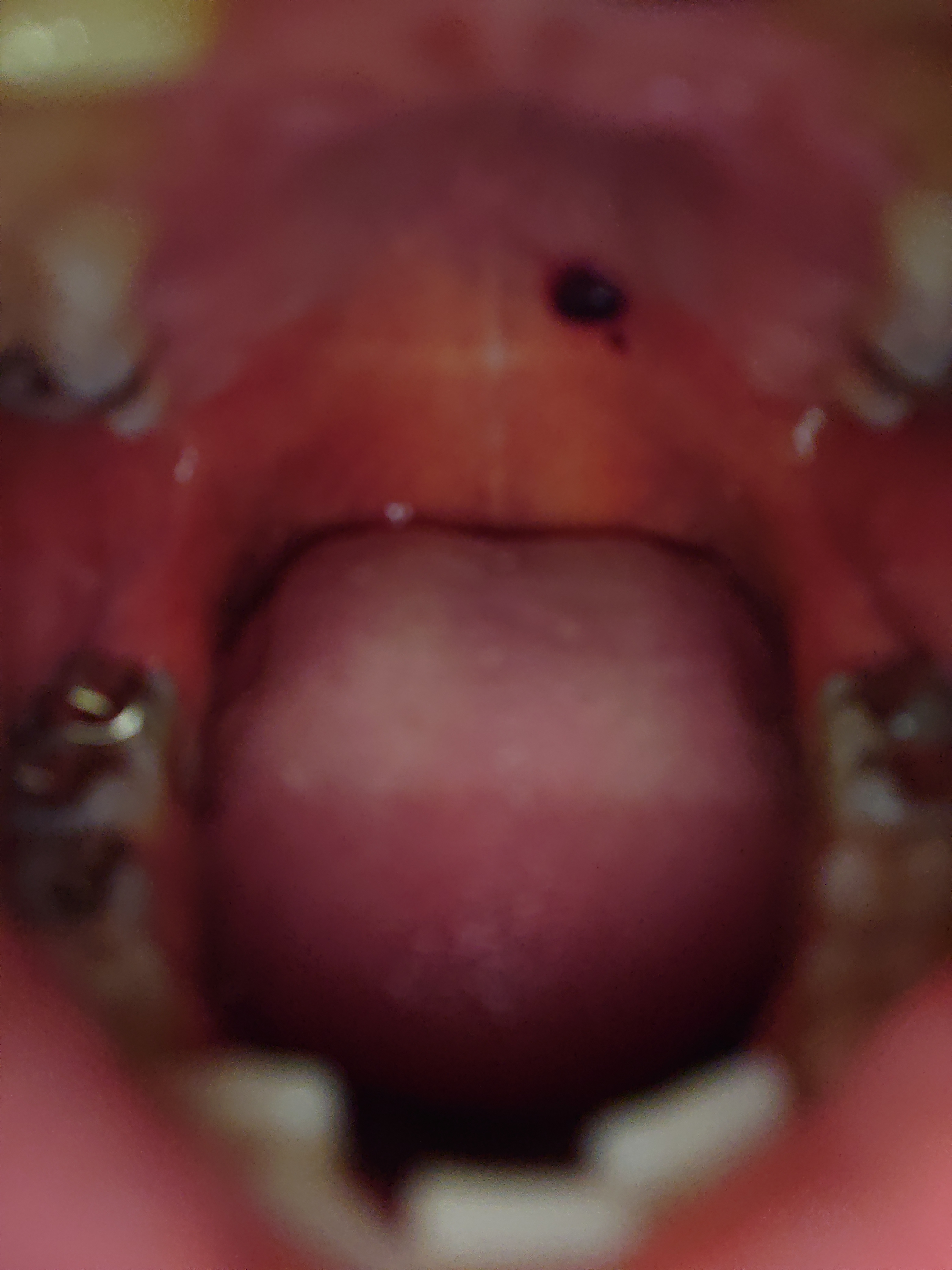 口内 血豆 口の中に血豆が突然できた 血袋の原因と対処方法